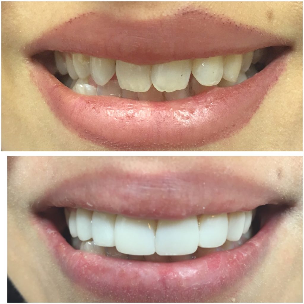 Before & After work done by Our Doctor’s Centre Dental